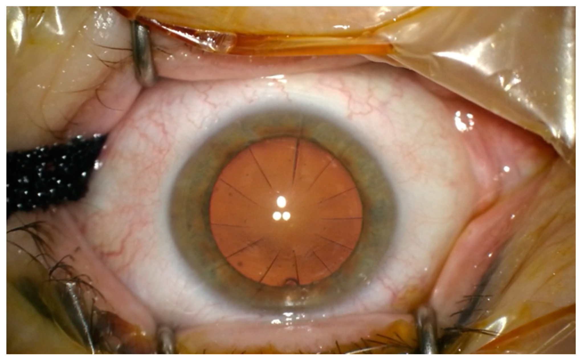 Medicina | Free Full-Text | Cataract Surgery after Radial Keratotomy with  Non-Diffractive Extended Depth of Focus Lens Implantation