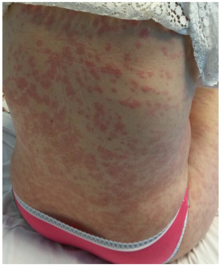 Treating PUPPP (Late Pregnancy Rash) « Mommy News and Views Blog