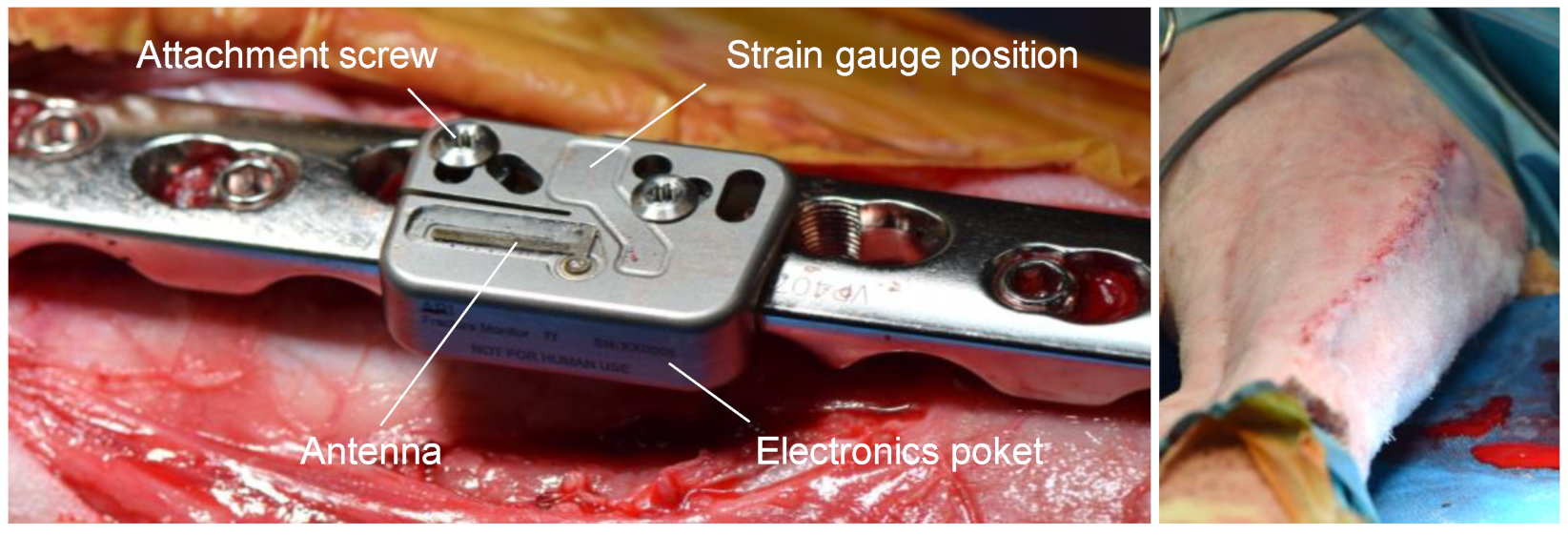 Self-powered implantable device stimulates fast bone healing, then