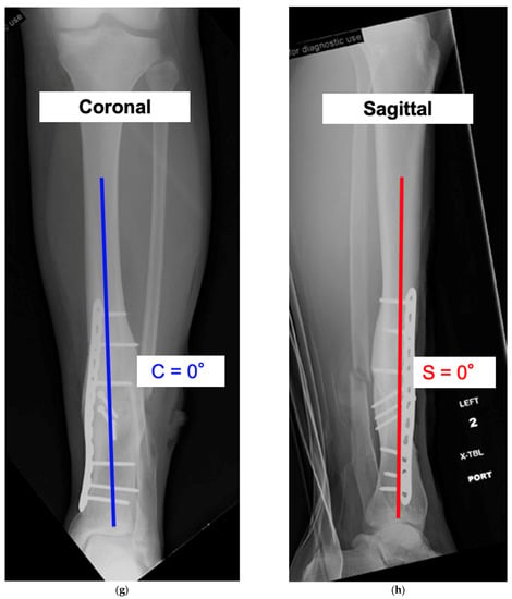 Malunited fracture - tibia, Radiology Case