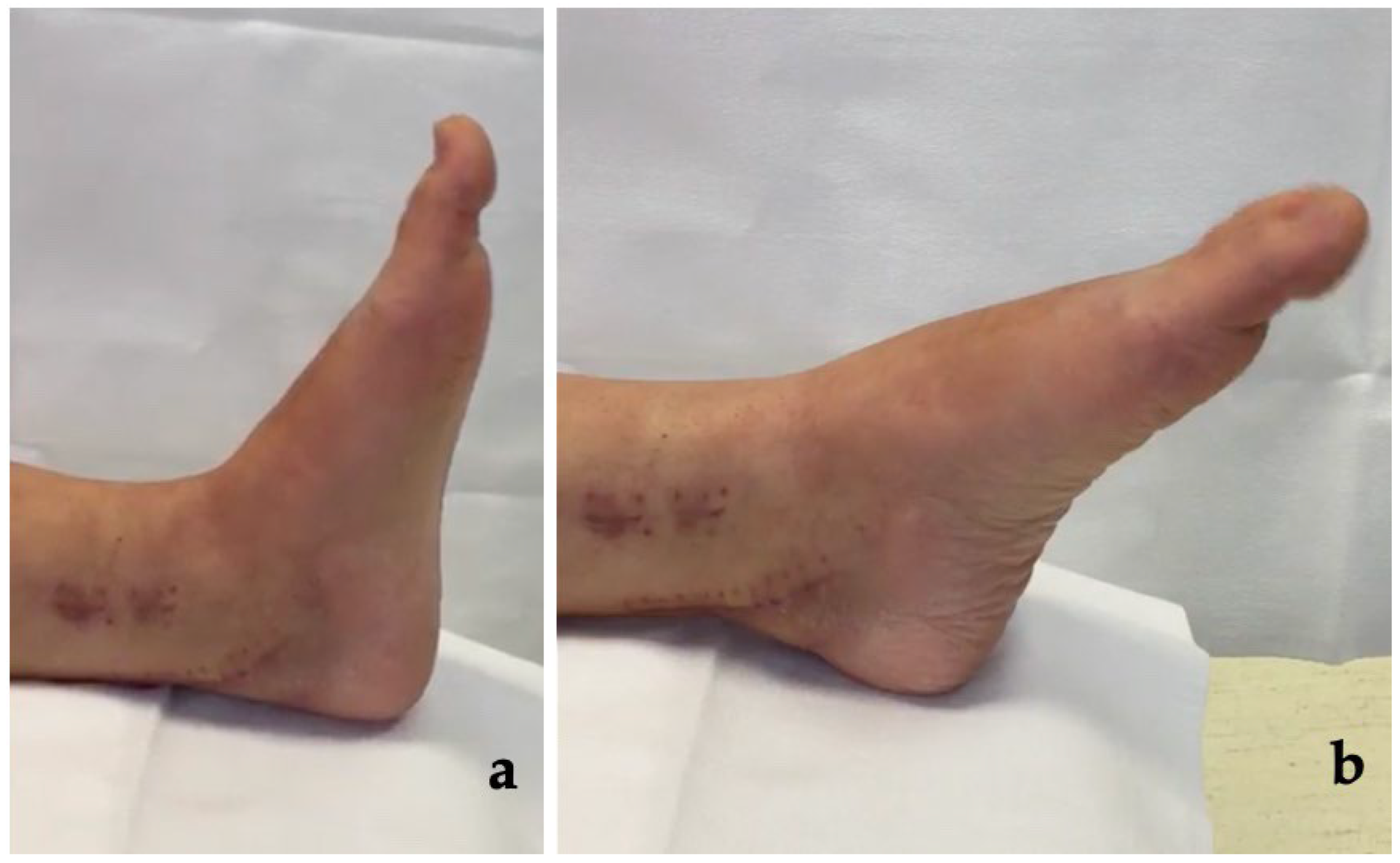 PDF) Passive Stretching Does Not Enhance Outcomes in Patients With  Plantarflexion Contracture After Cast Immobilization for Ankle Fracture: A  Randomized Controlled Trial