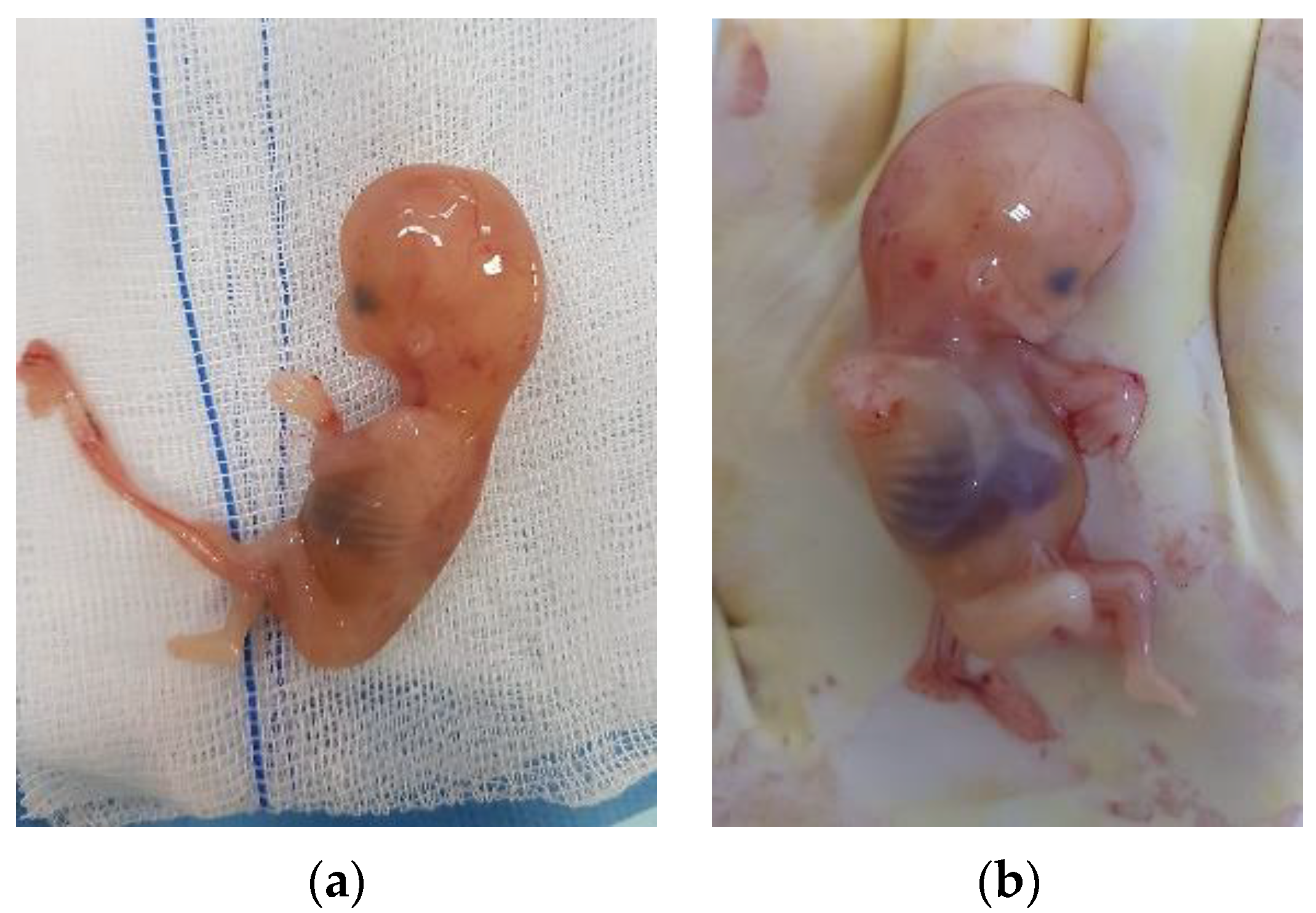 Thirty-seven-year-old female with ruptured ectopic pregnancy