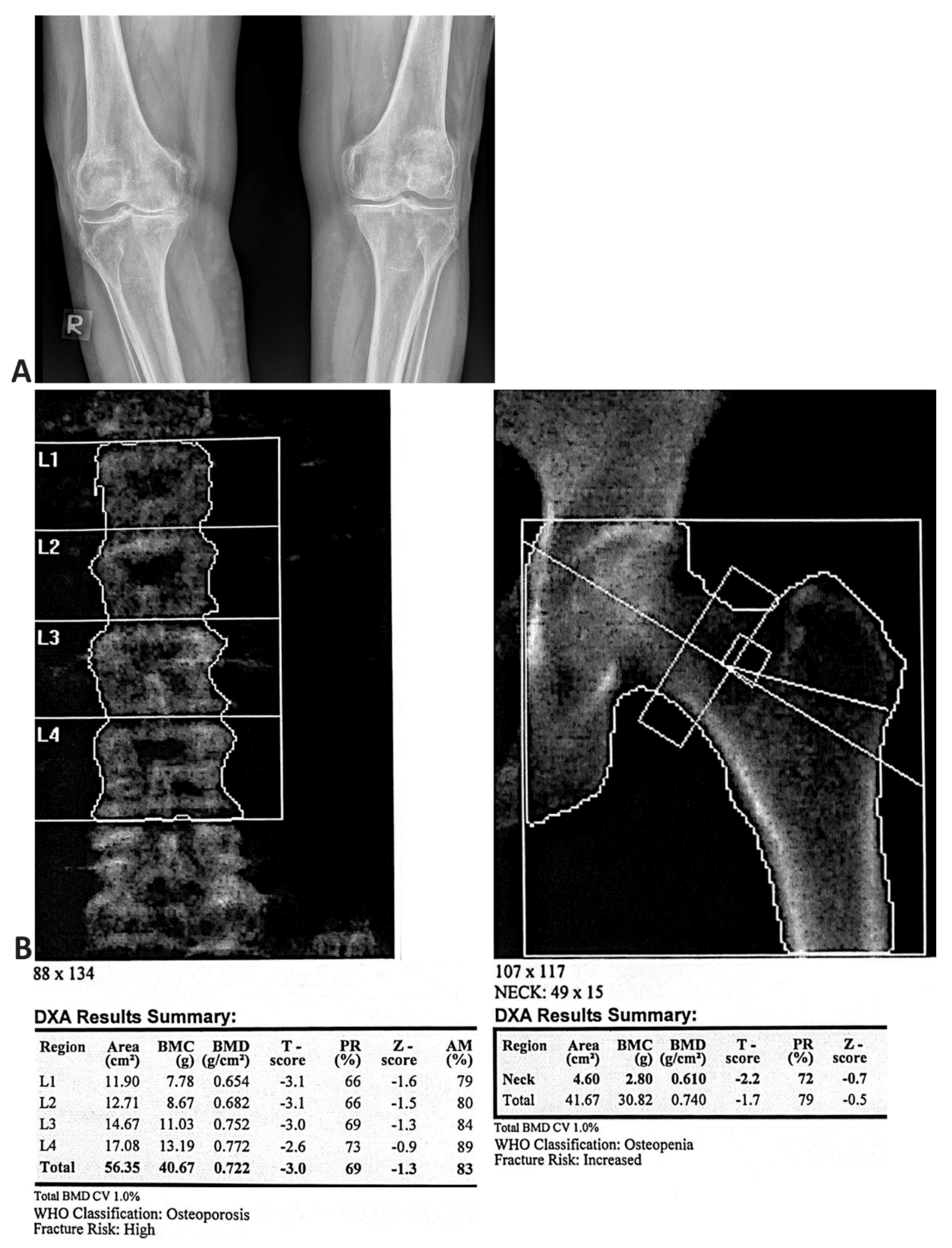 DEXA Bone Density  Arthritis & Sports