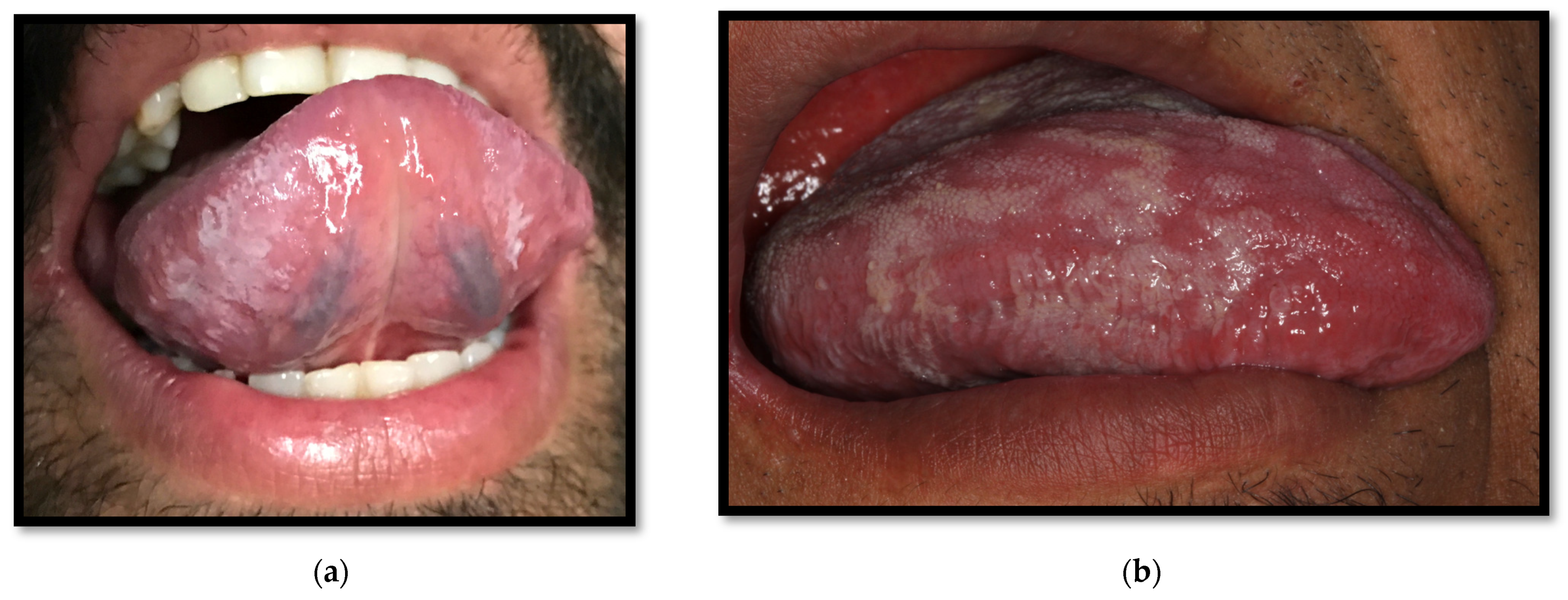 hiv tongue lesions