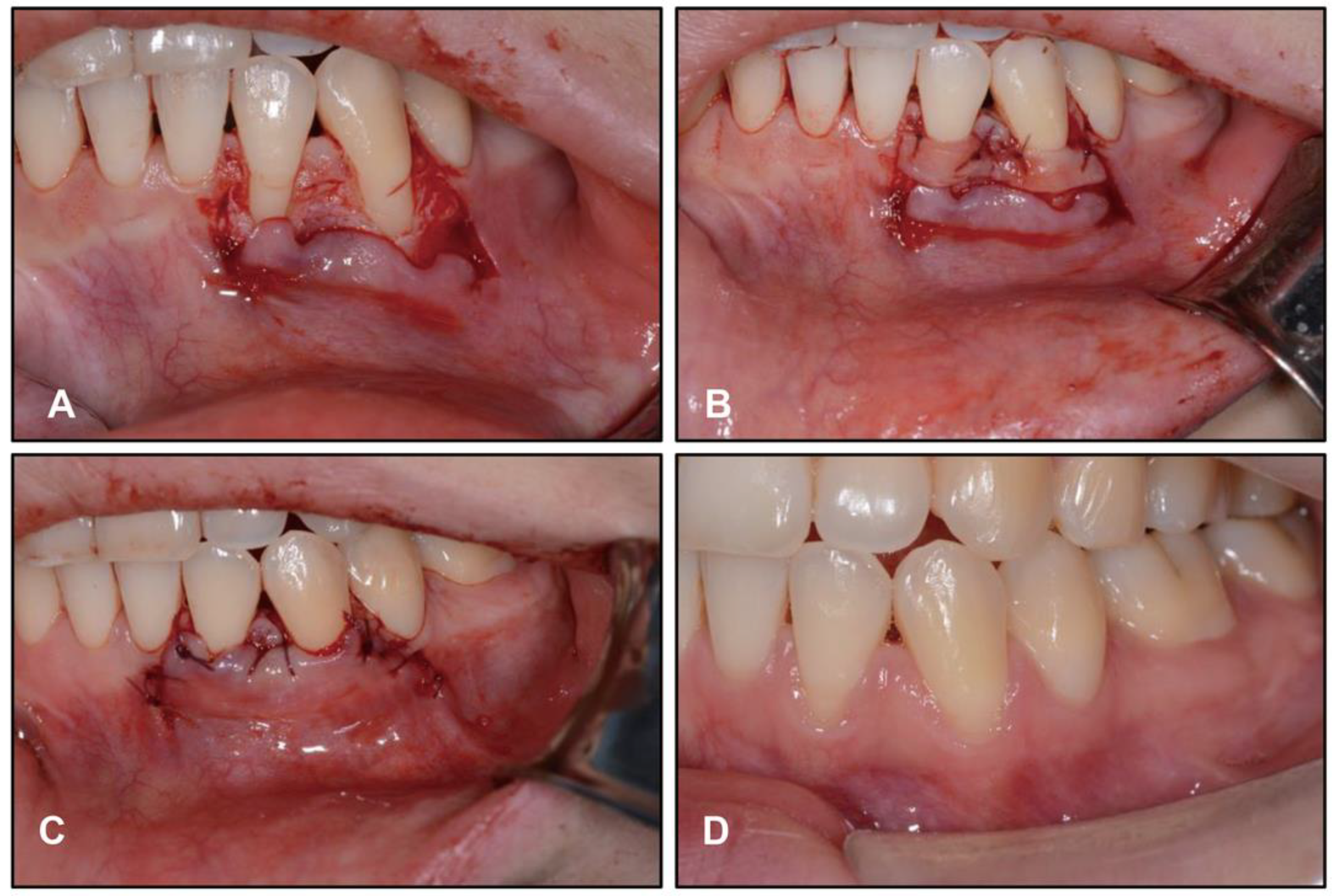 Stability of a severe Class II malocclusion correction in a