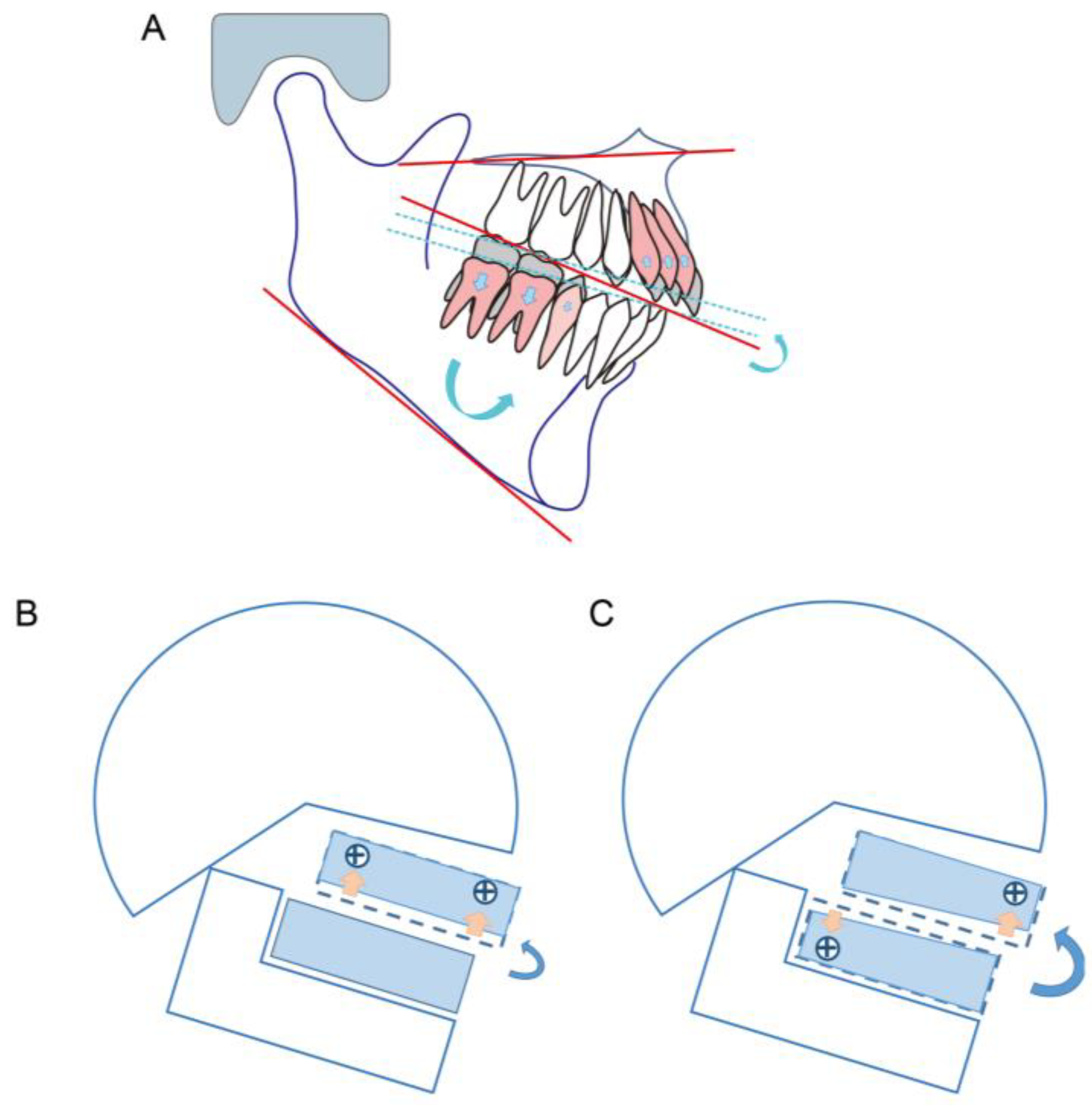 PDF) Changes in the anterior and posterior occlusal plane in nongrowing  females with hyperdivergent skeletal Class II malocclusion treated with mini-implant  anchorage
