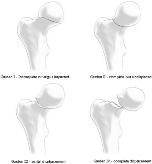 Medicina | Free Full-Text | Proximal Femoral Fractures in the Elderly ...