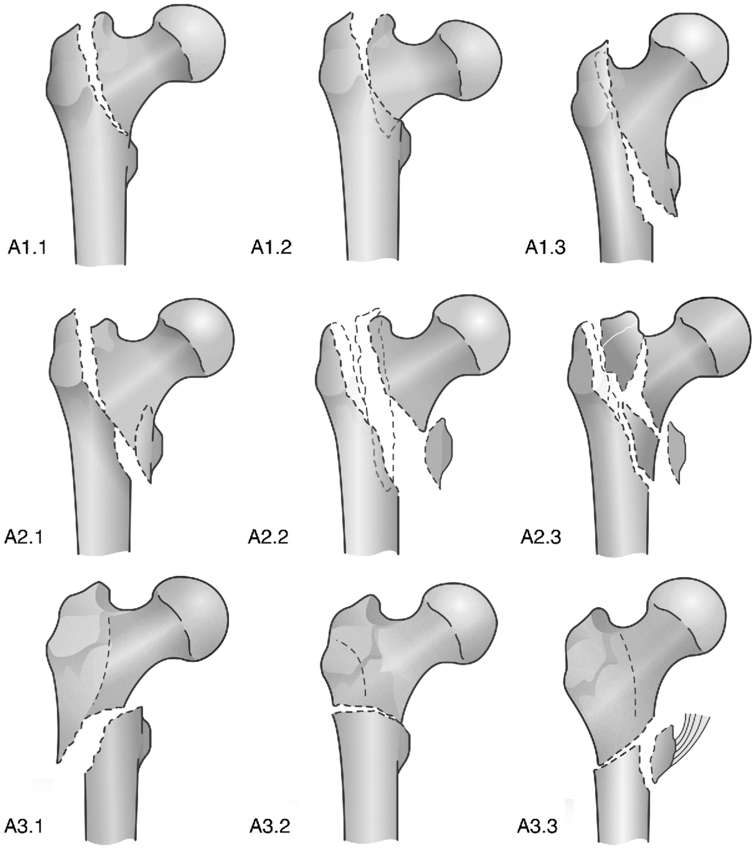 Medicina | Free Full-Text | Proximal Femoral Fractures in the Elderly: A  Few Things to Know, and Some to Forget