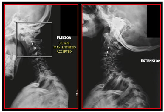 Deep Neck Flexor Weakness and Cervicogenic Headache - Illinois Chiropractic  Society