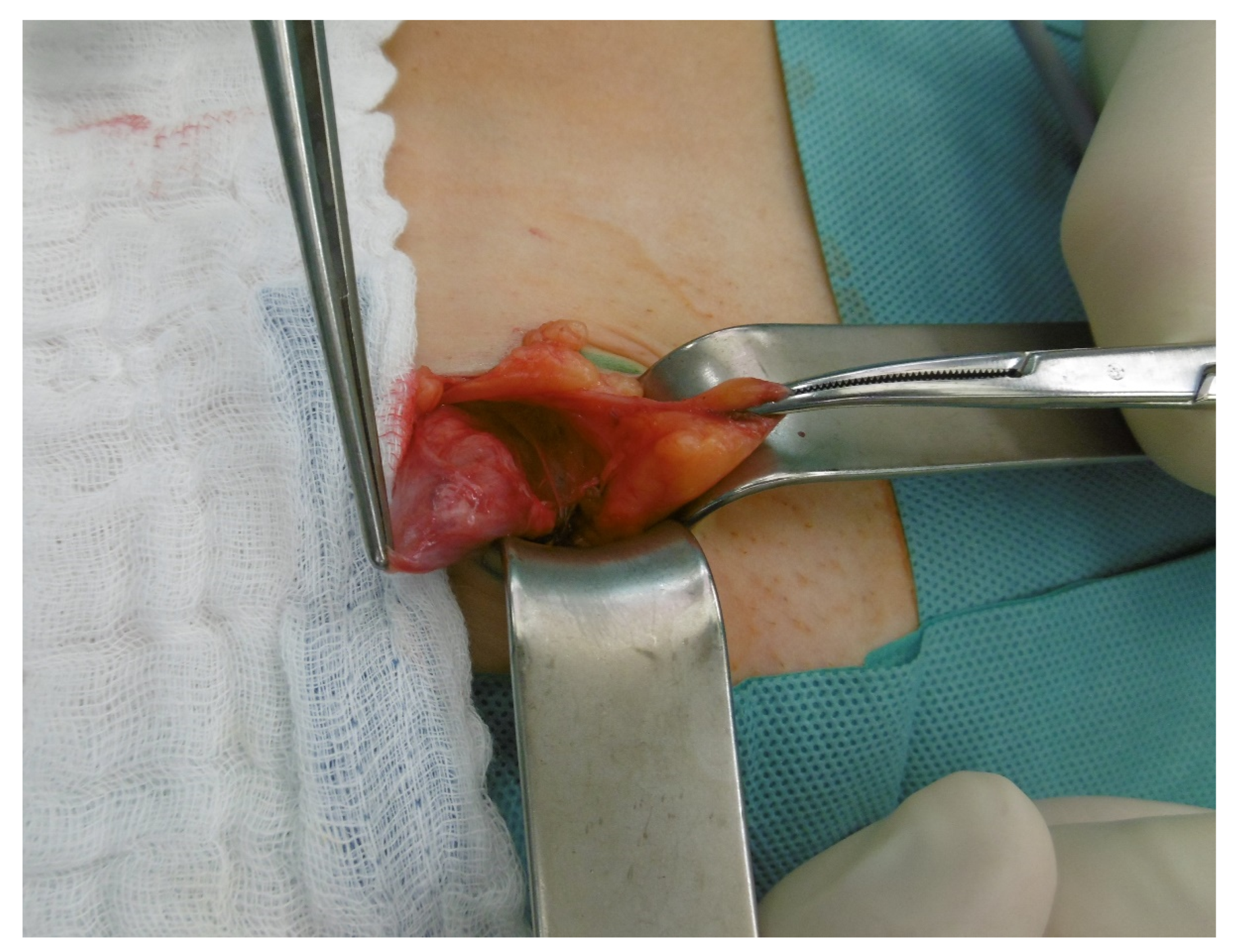 Muscle hernia in a 40-year-old man with a tender palpable mass at