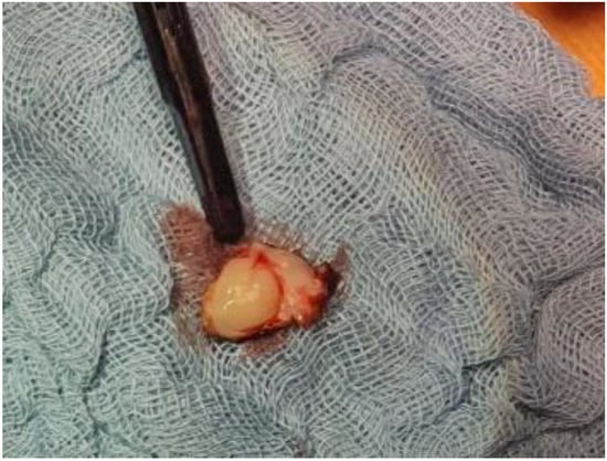 Medicina | Free Full-Text | A Rare Case of Left Ventricular Malignant  Peripheral Nerve Sheath Tumour&mdash;Case Report and Review of the  Literature | HTML