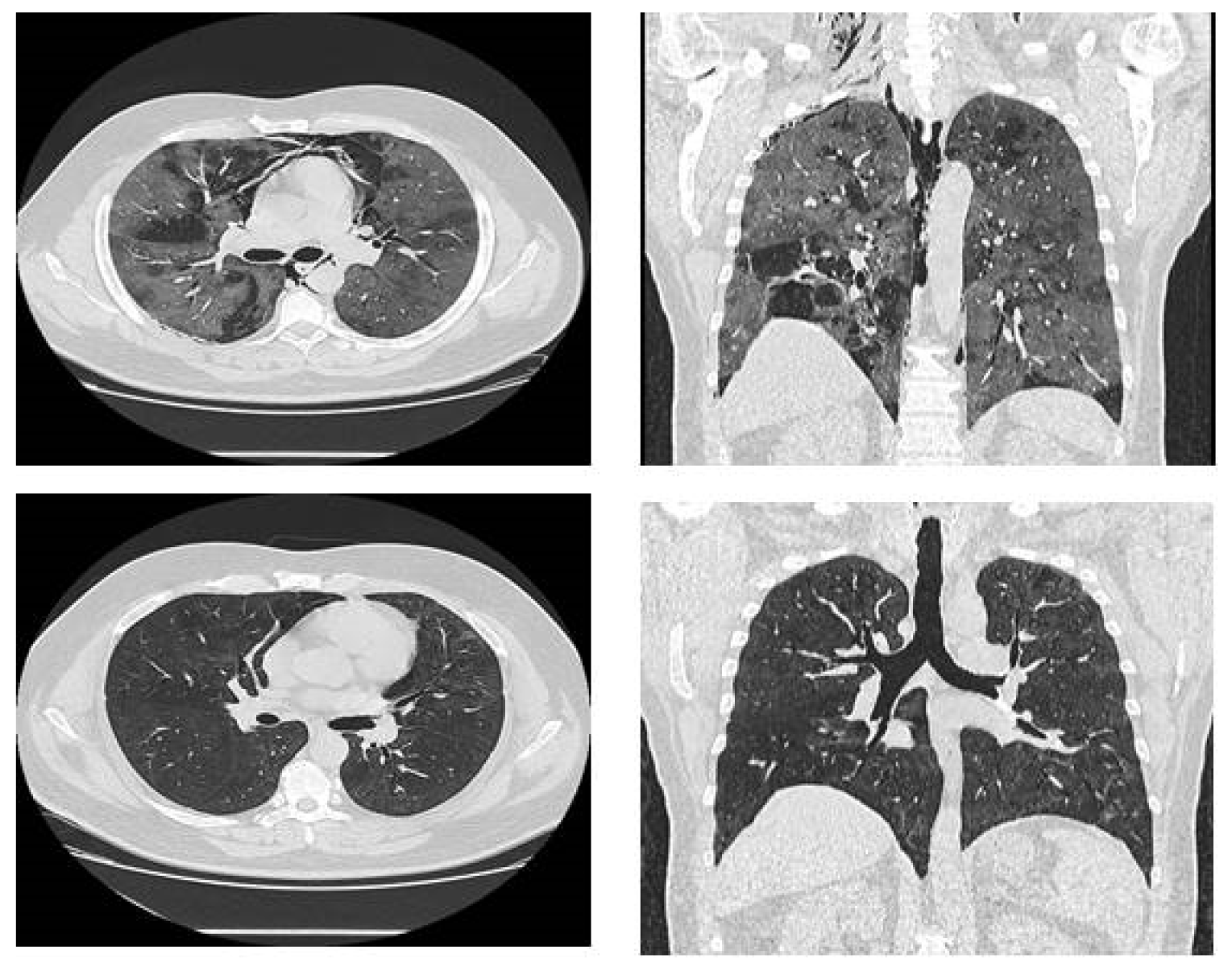 Medicina Free Full Text Massive Spontaneous Pneumomediastinuma