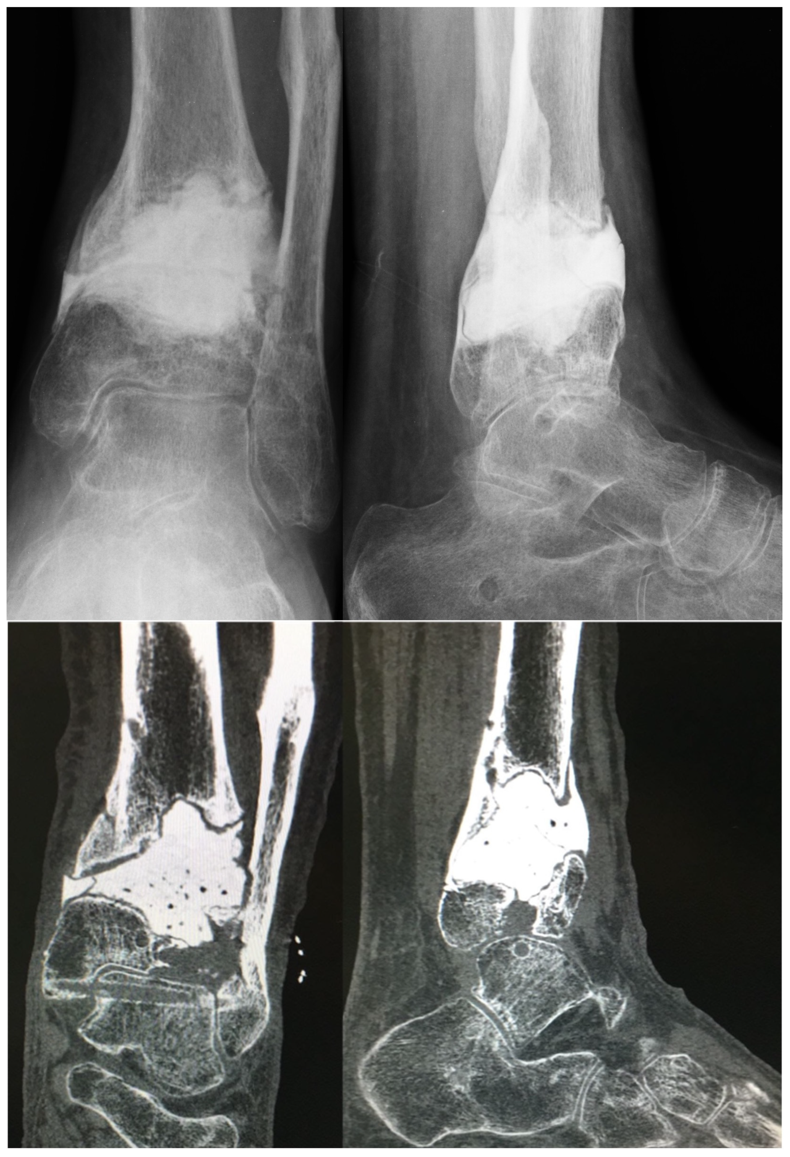 Posttraumatic Reconstruction of the Ankle Using the Ilizarov