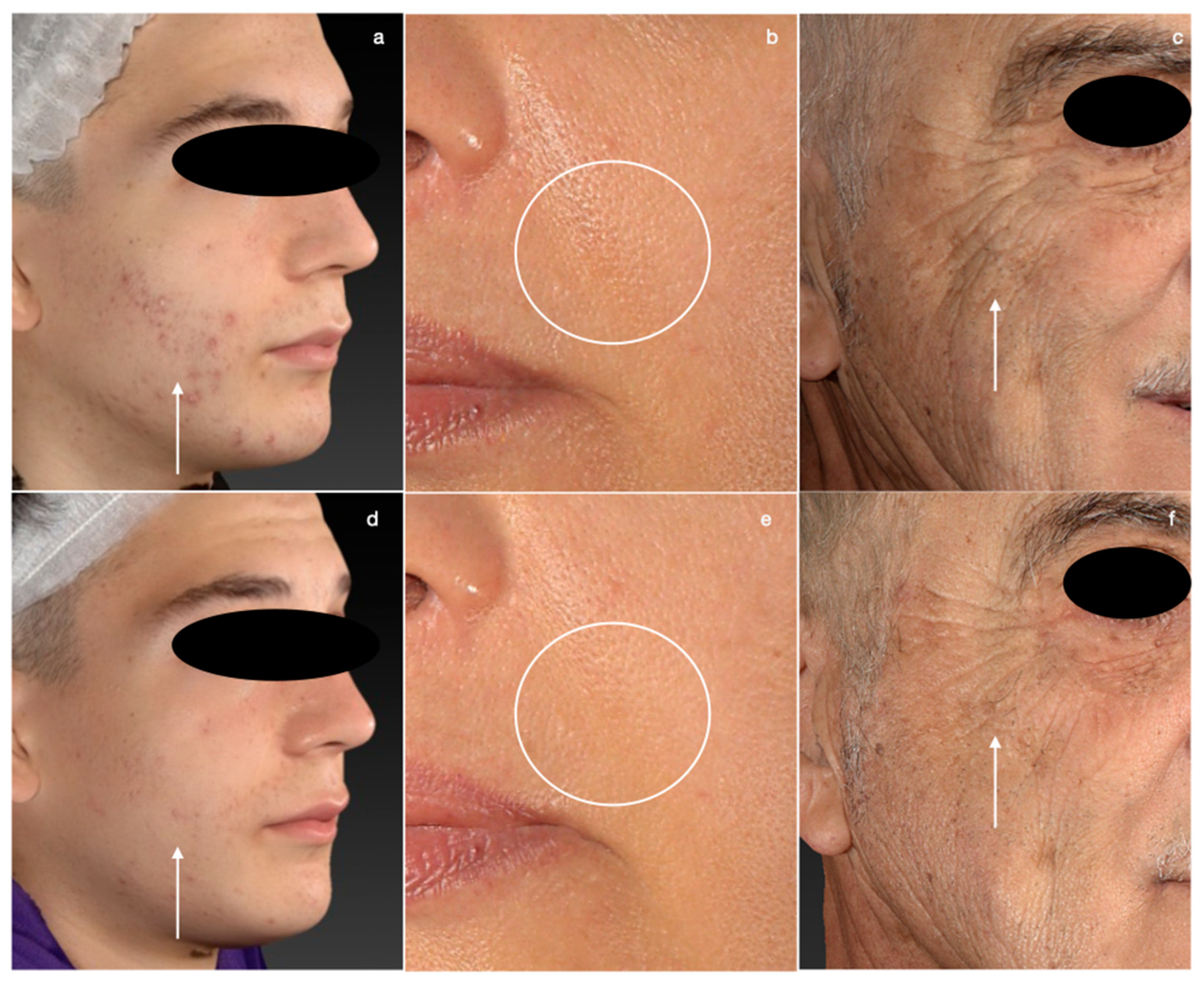 Medicina | Free Full-Text | Carbon Peeling Laser Treatment to Improve Skin  Texture, Pores and Acne Lesions: A Retrospective Study