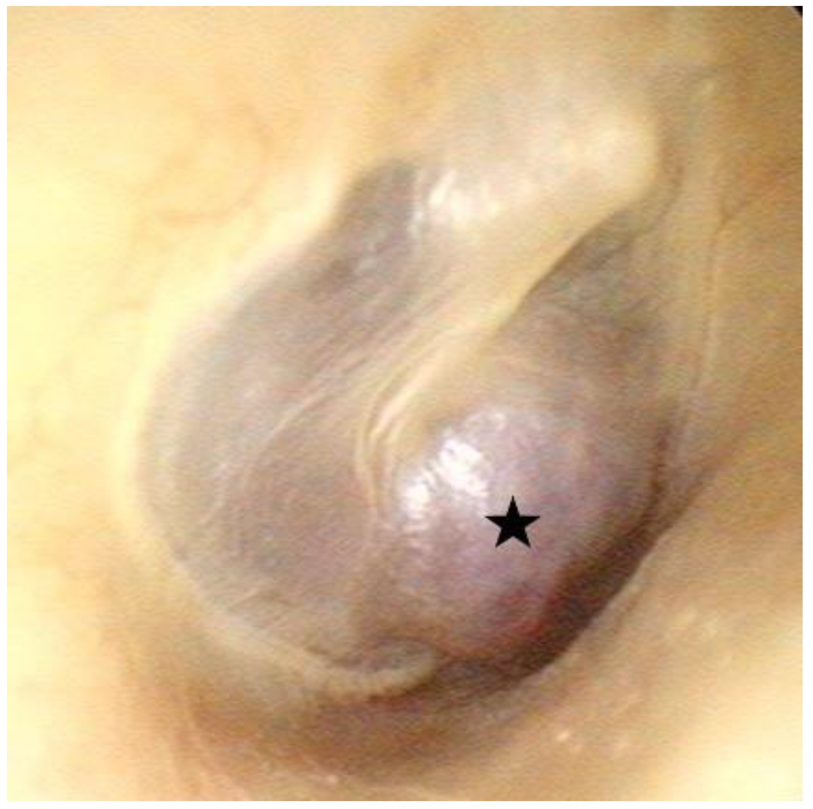 internal carotid artery in ear