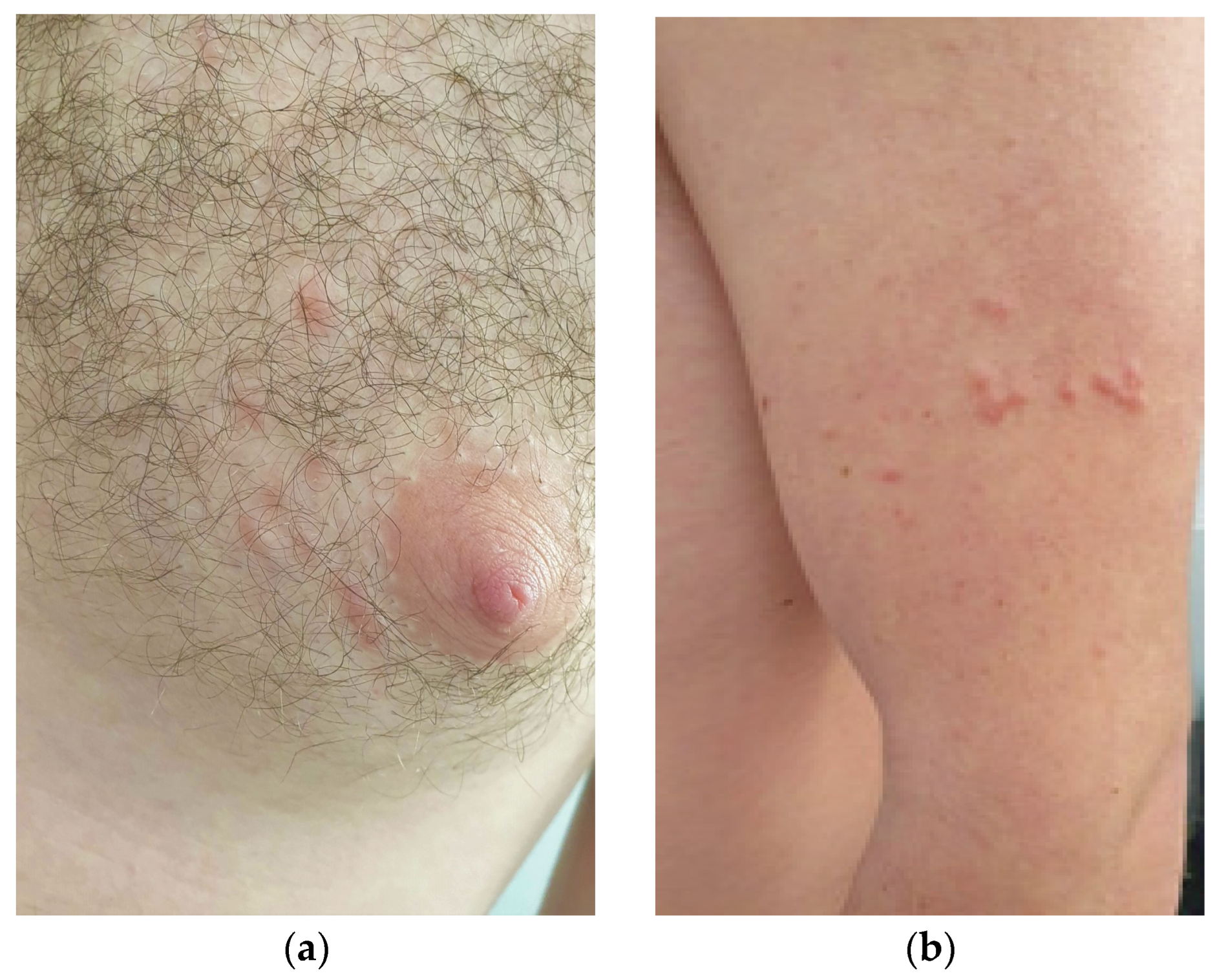 Dermoscopic feature of dermatofibroma of the patient. Central