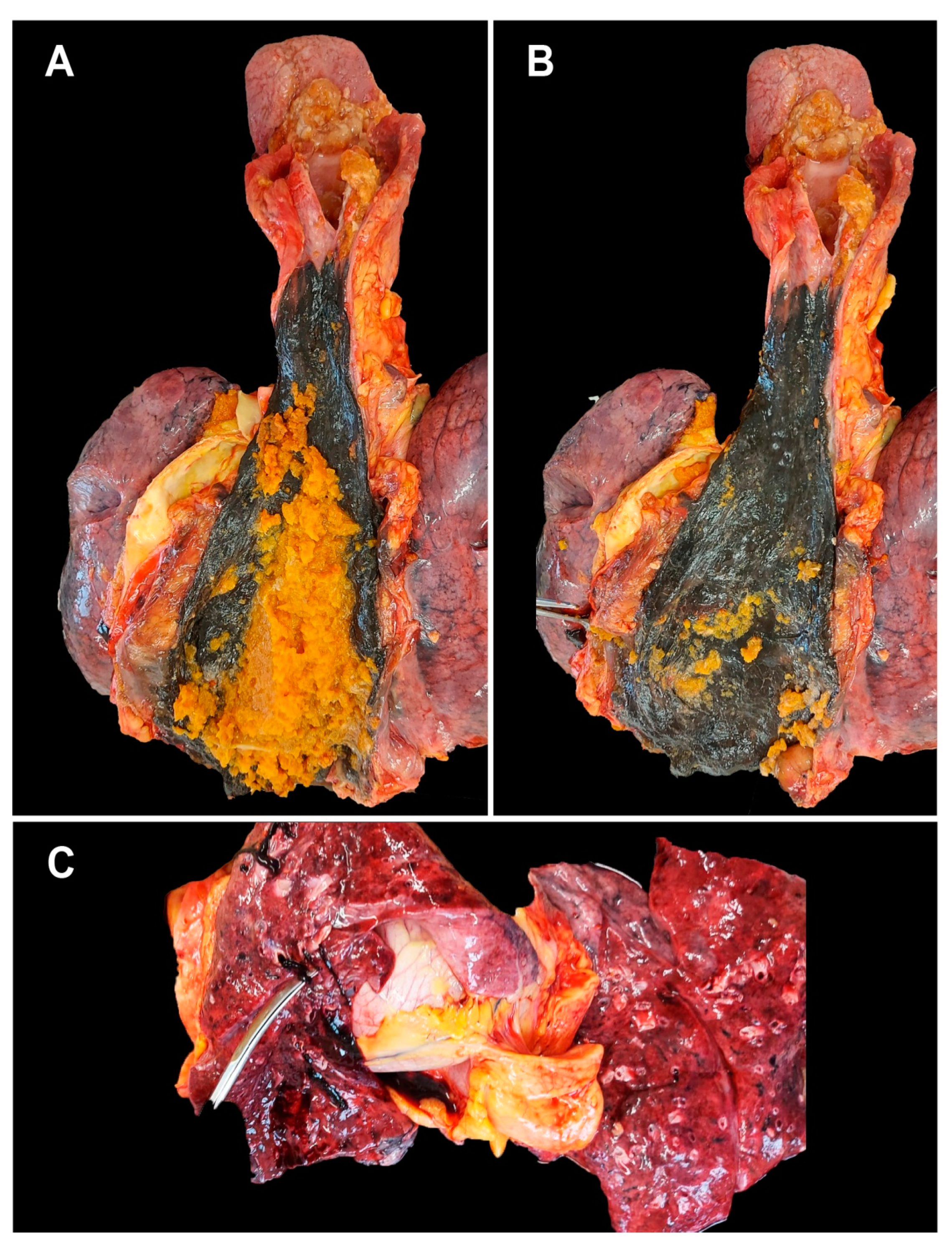 Medicina | Free Full-Text | Asymptomatic Esophageal Necrosis in a Patient  with Recent COVID-19: The First Case Diagnosed through Autopsy