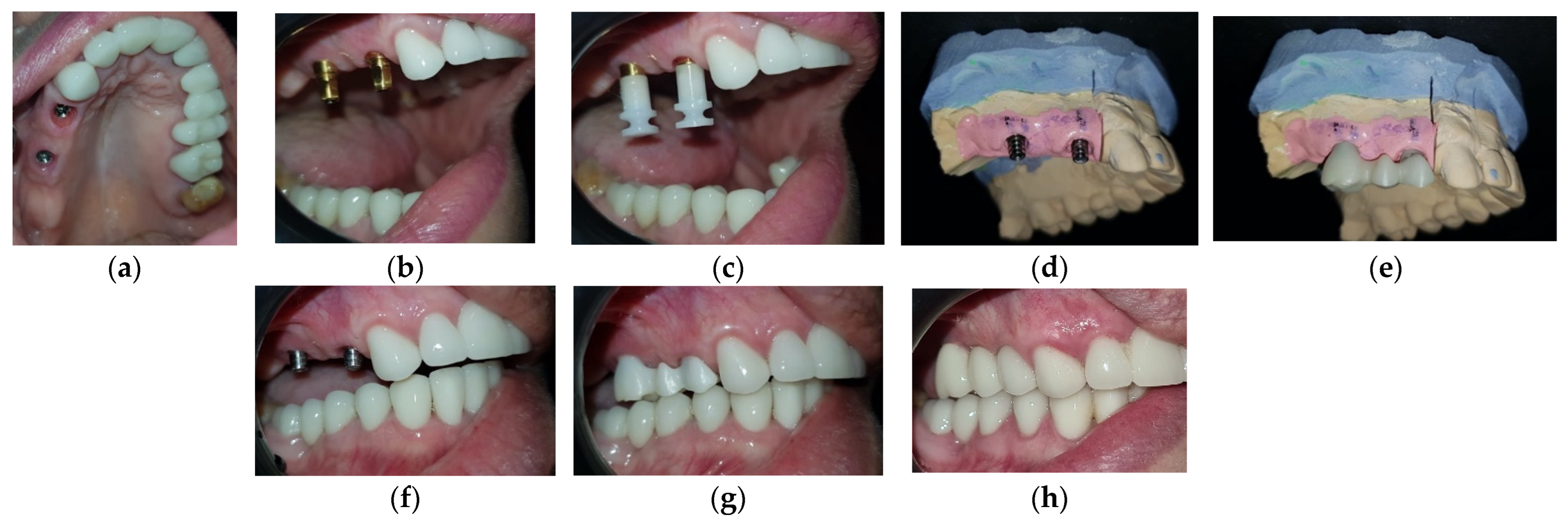 Medicina | Free Full-Text | Full-Mouth Rehabilitation of a Patient with ...