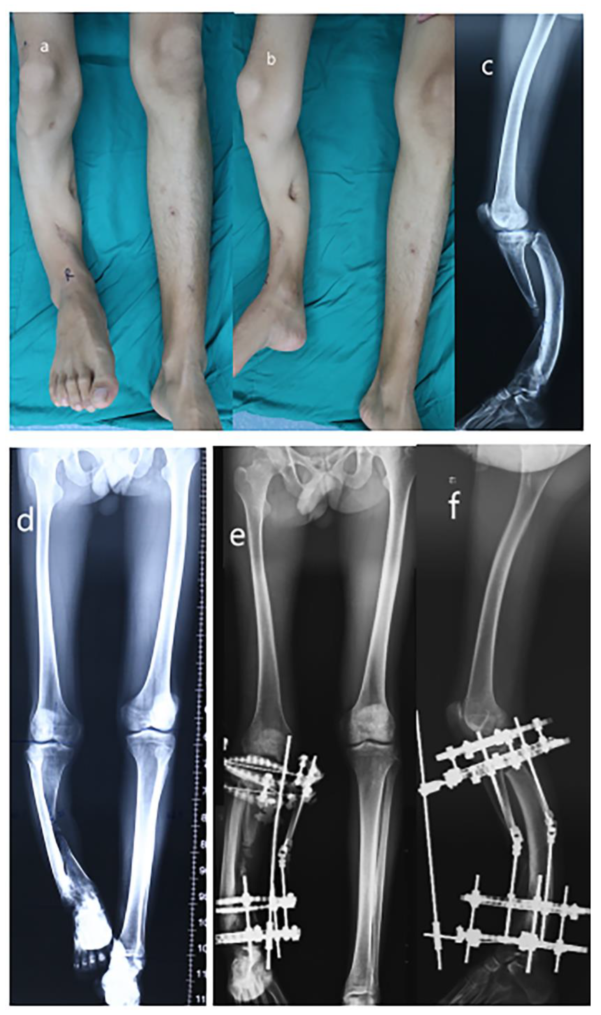 Medicina | Free Full-Text | A Combination of Ilizarov Frame, Externalized  Locking Plate and Tibia Bridging for an Adult with Large Tibial Defect and  Severe Varus Deformity Due to Chronic Osteomyelitis in