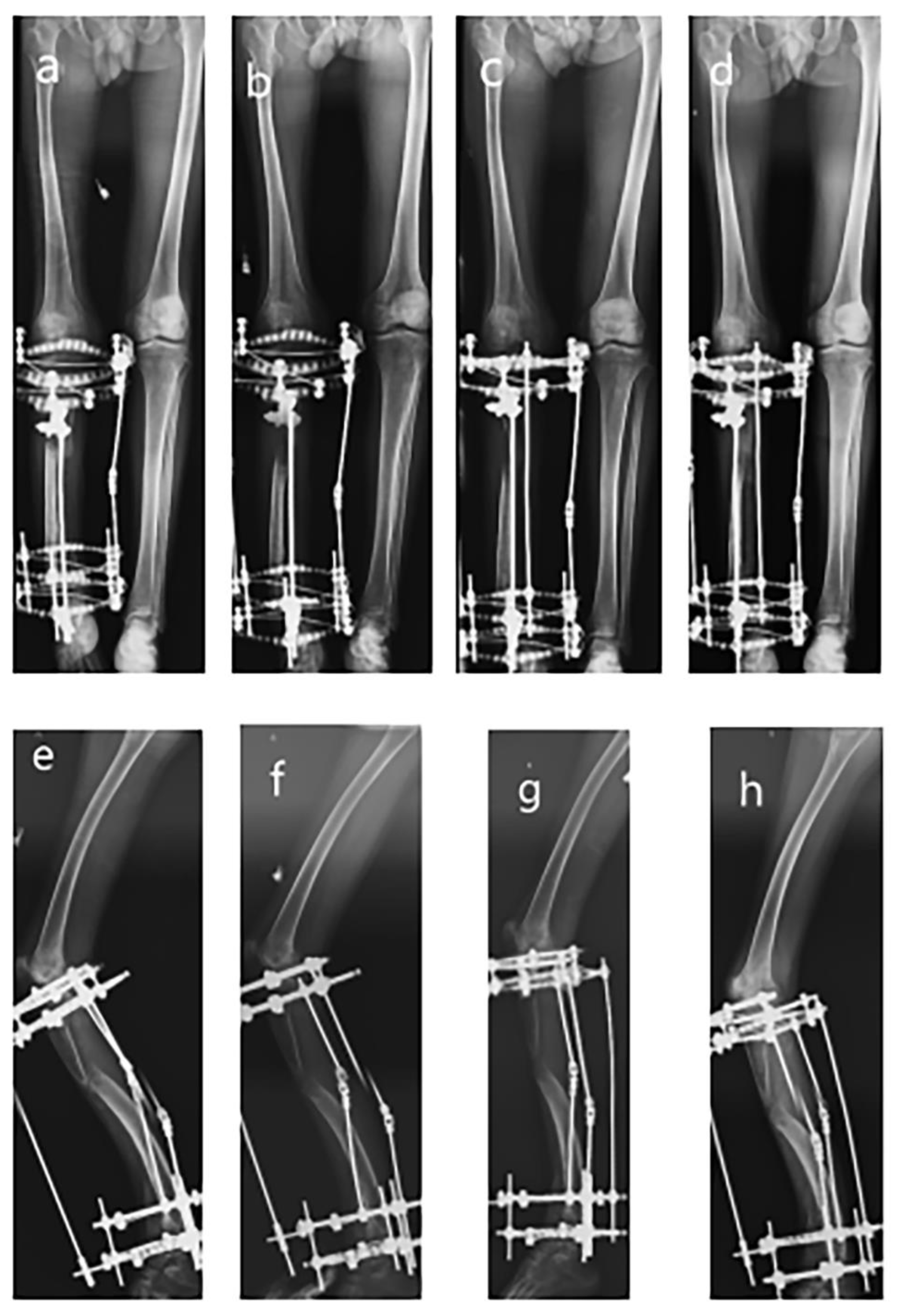 Llizarov Tibia Ring External Fixator Lengthening for Delayed