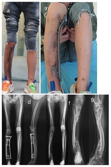 Full-ring Ilizarov frame applied for lengthening of tibia.