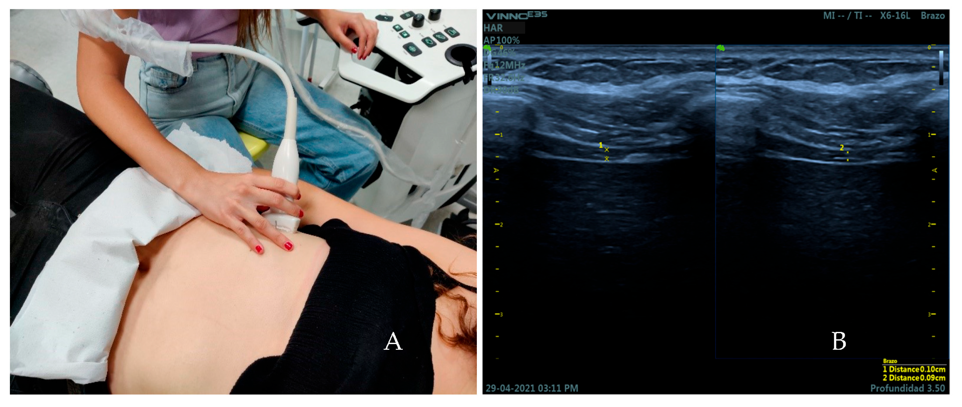 Medicina | Free Full-Text | Diaphragmatic Activation Correlated with Lumbar  Multifidus Muscles and Thoracolumbar Fascia by B-Mode and M-Mode  Ultrasonography in Subjects with and without Non-Specific Low Back Pain: A  Pilot Study