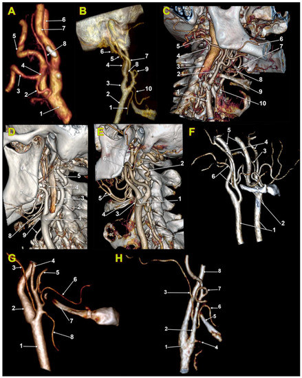 Medicina Free Full Text Vertical Levels Of The Occipital Artery Origin 3925