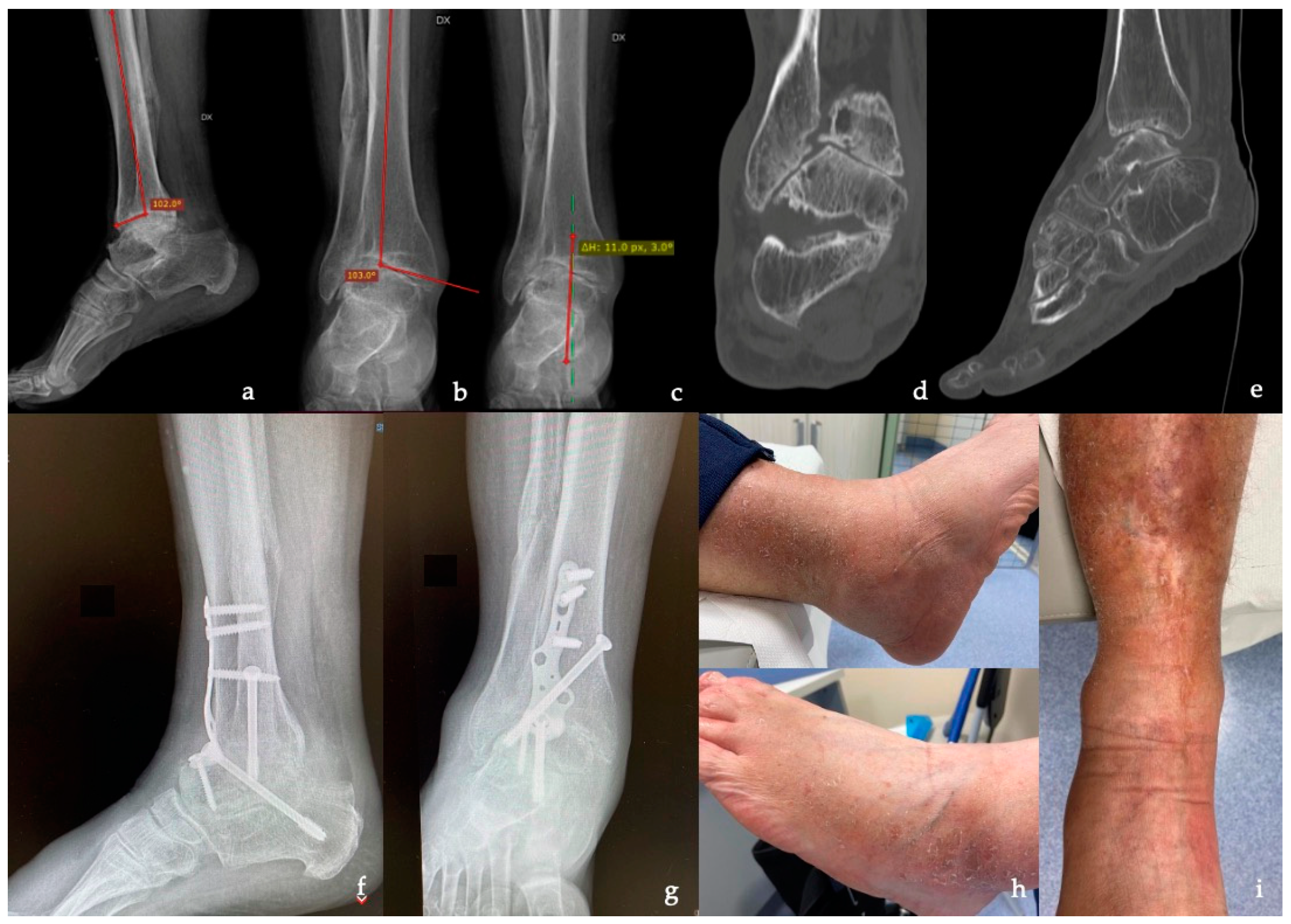 Analysis of bone transport for ankle arthrodesis as a limb salvage  procedure for the treatment of septic pilon fracture nonunion