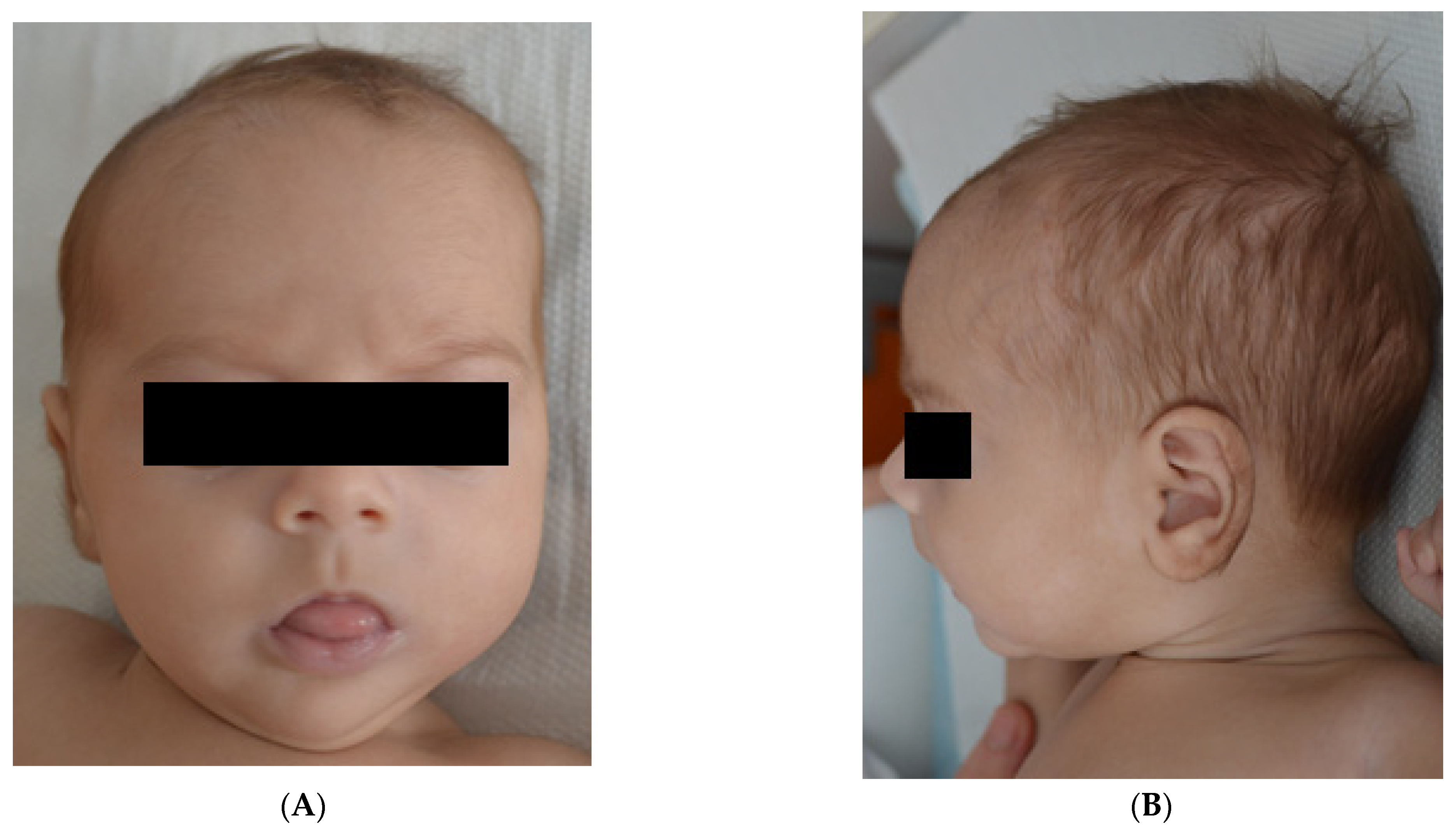 Medicina | Free Full-Text | Unusual Association of Diamond&ndash;Blackfan  Anemia and Severe Sinus Bradycardia in a Six-Month-Old White Infant: A Case  Report and Literature Review