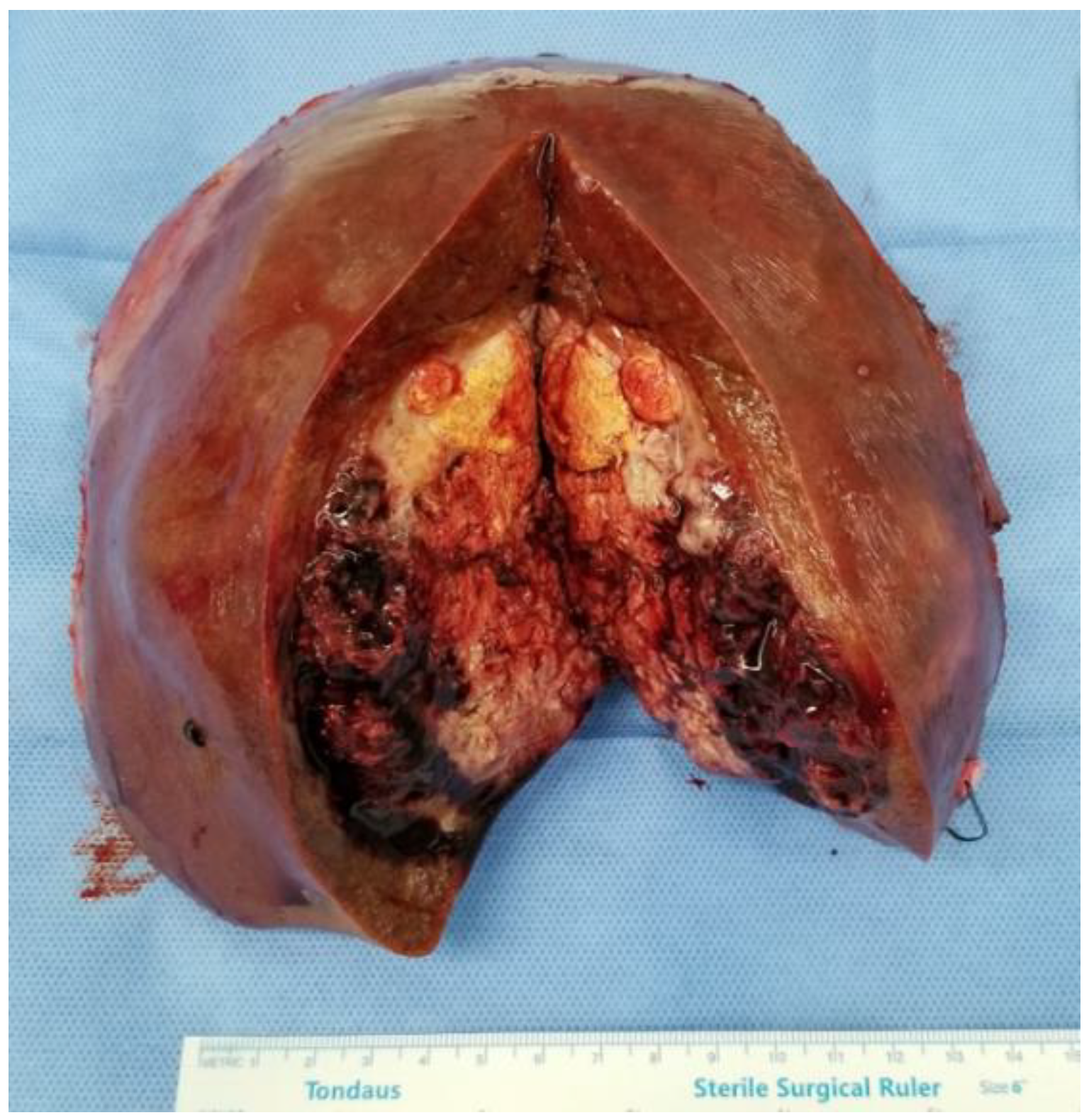 hepatocellular carcinoma gross