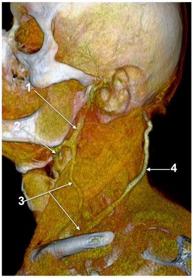 Anatomical Variations Of The External Jugular Vein A Pictorial And Critical Review 4223