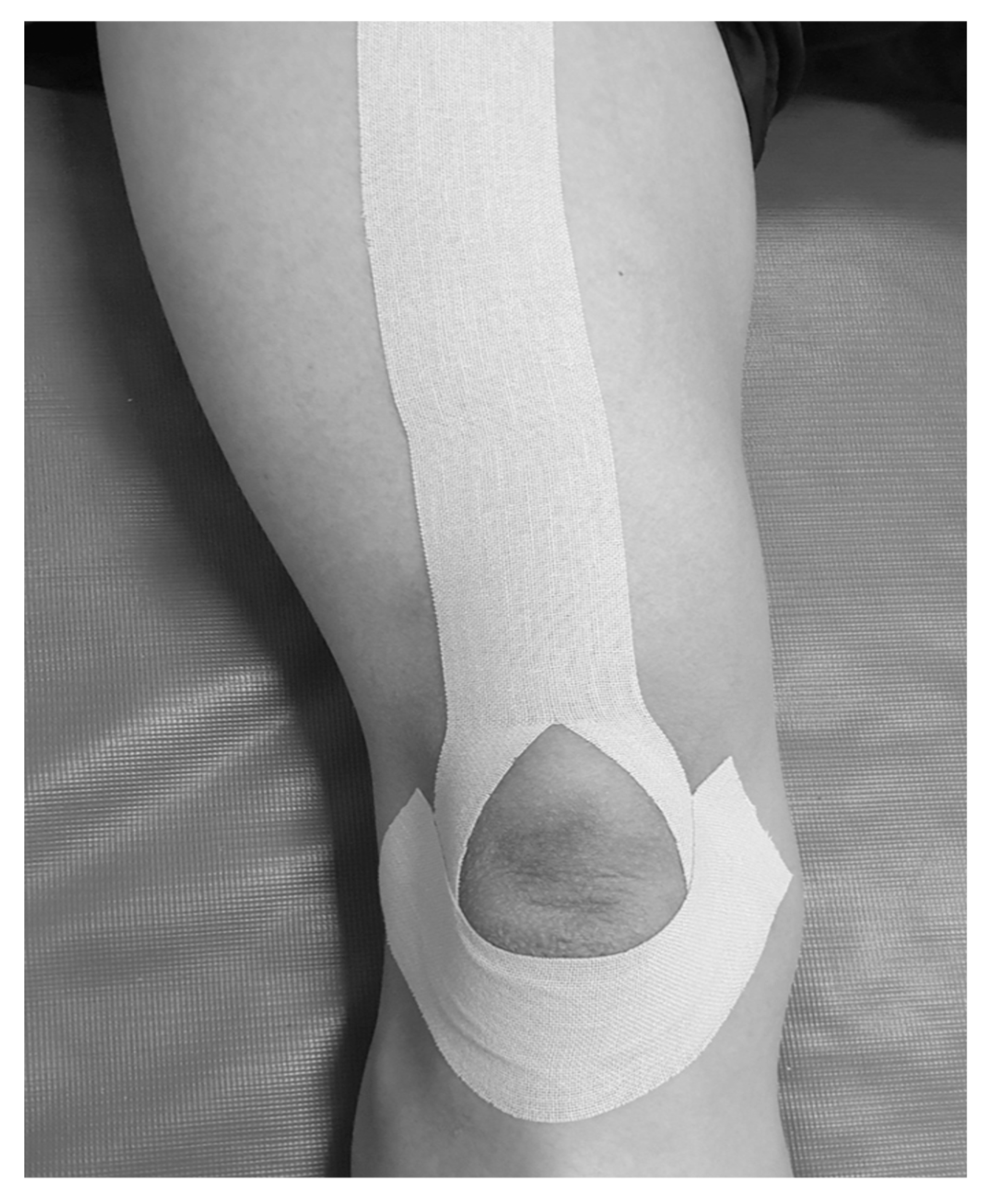 Medicina | Free Full-Text | Effect of Adding Kinesio Taping to Exercise  Therapy in the Treatment of Patellofemoral Pain Syndrome