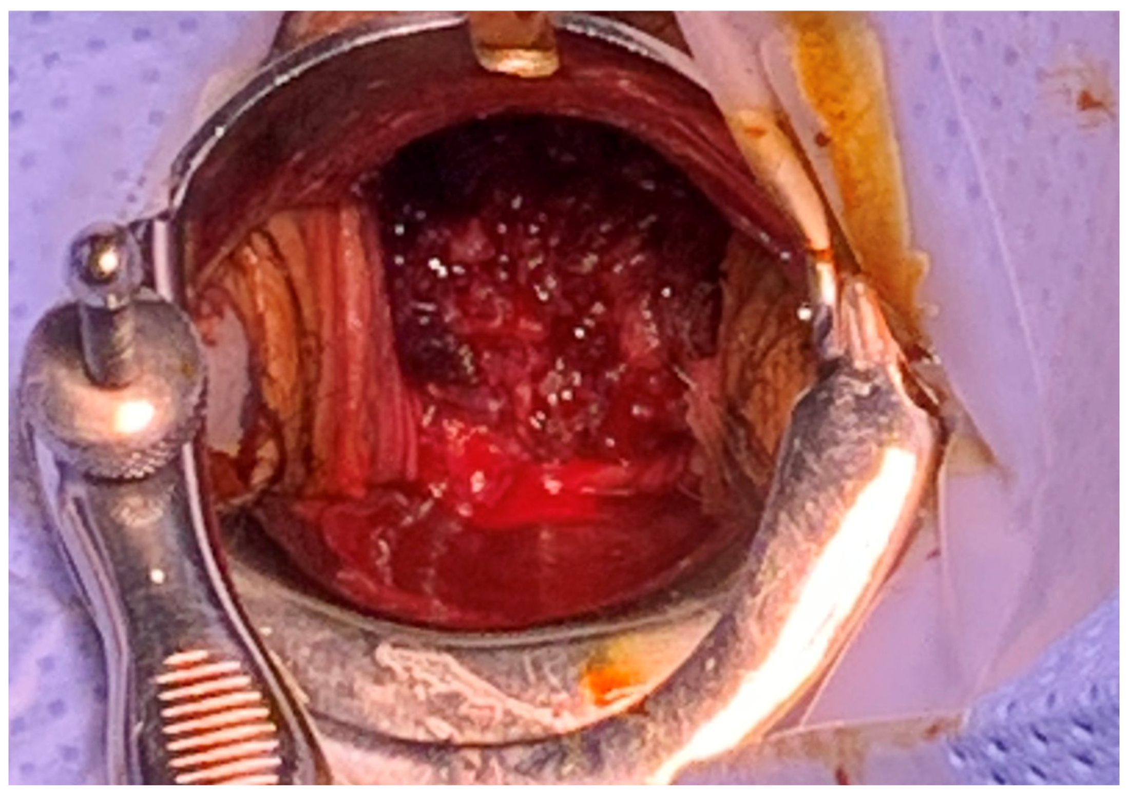 Photographs from laparoscopy showing: (A) internal bleeding