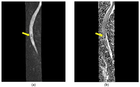 Jcm Free Full Text Intramedullary Spinal Cord Abscess With