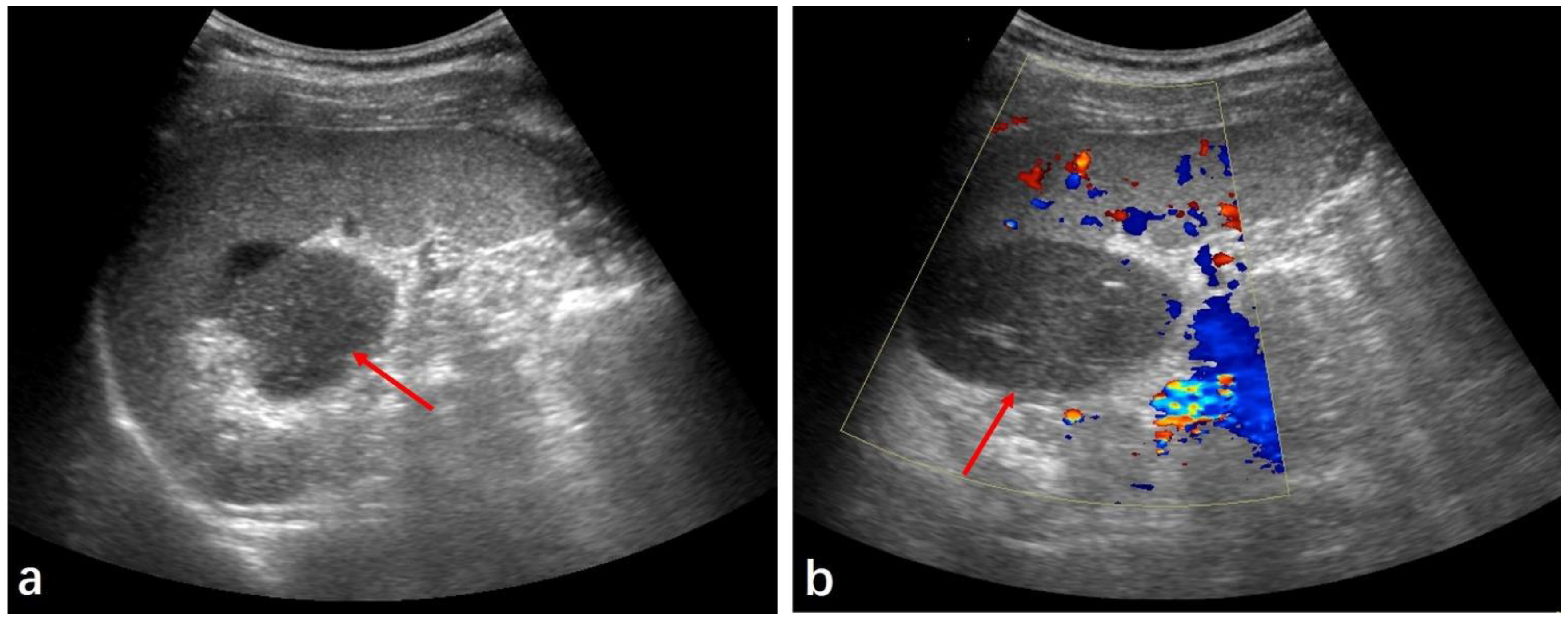 Medicina | Free Full-Text | Radiologic Findings of Single Accessory ...