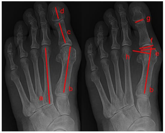 Medicina | Free Full-Text | Correlations of Sesamoid Bone Subluxation ...