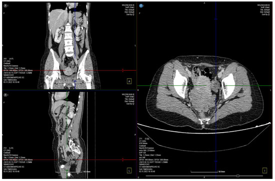 Pelvic Congestion Syndrome  CardioVascular Health Clinic