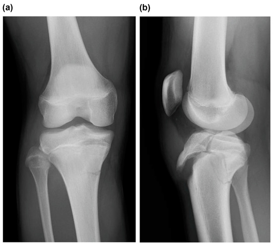 Medicina | Free Full-Text | Type V Tibial Tubercle Avulsion Fracture ...