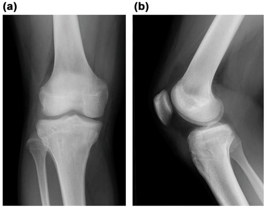 Medicina | Free Full-Text | Type V Tibial Tubercle Avulsion Fracture ...