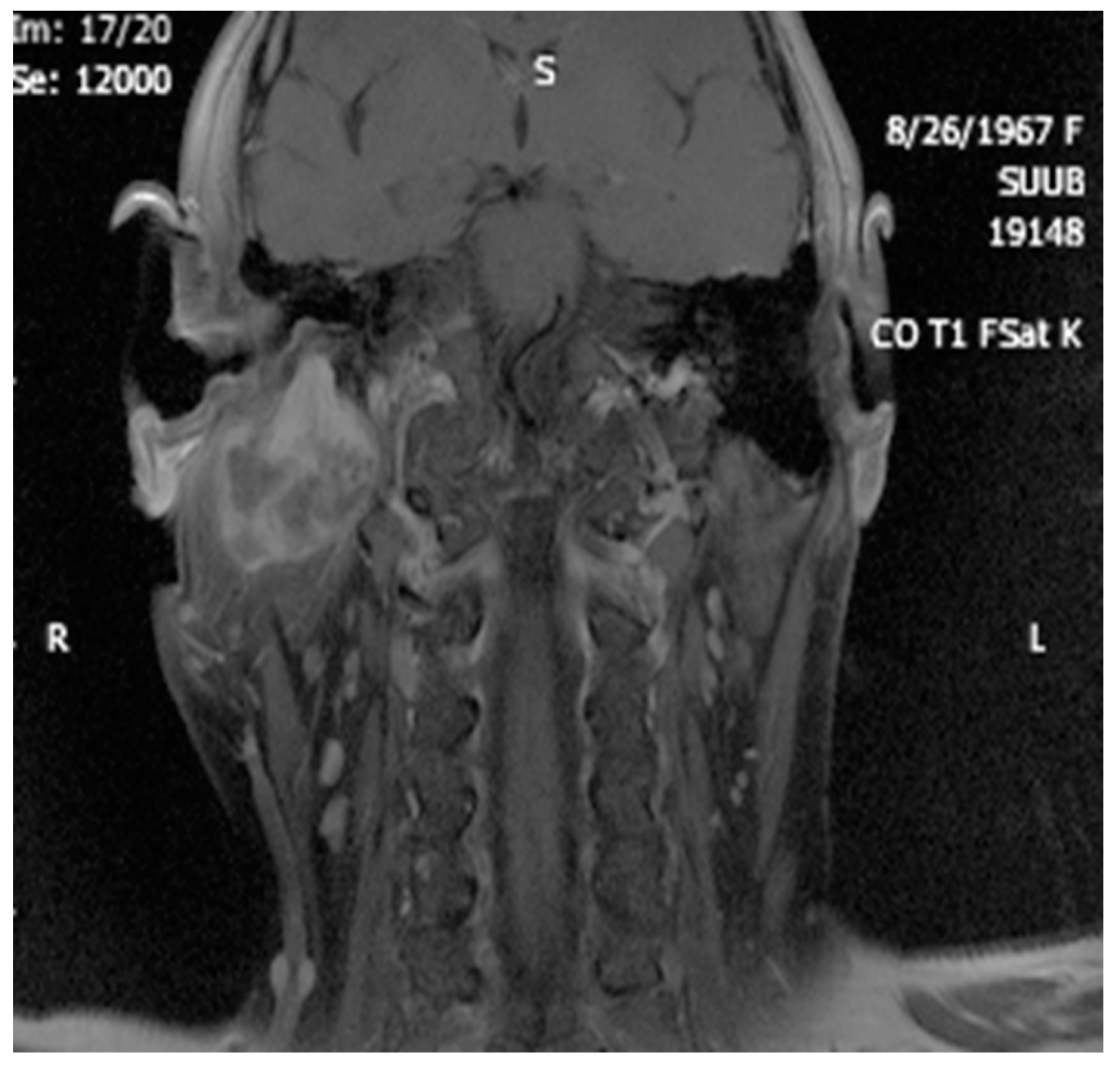 Medicina Free Full Text Extracranial Facial Nerve Schwannoma—histological Surprise Or 9505