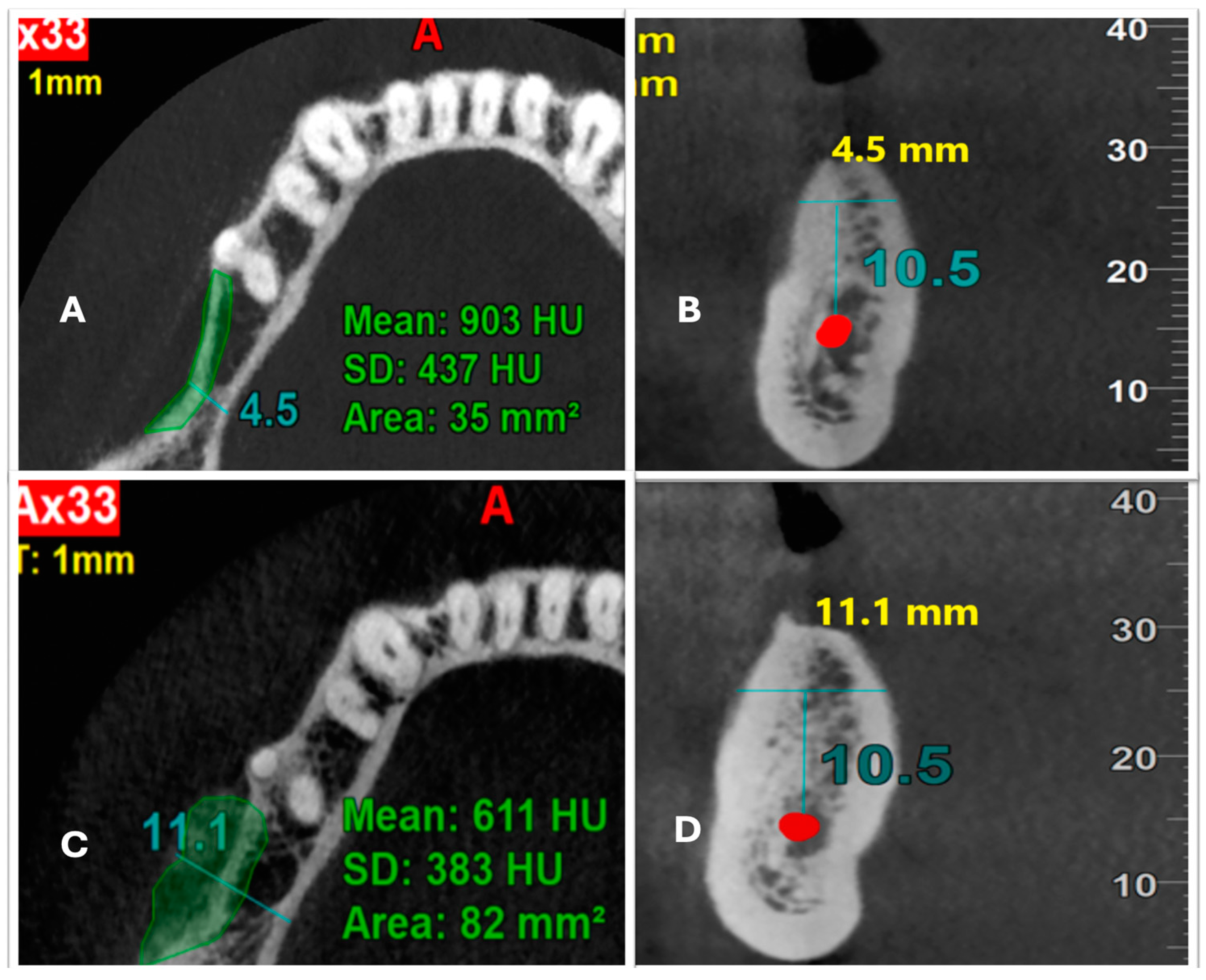 Medicina Free Full Text Alveolar Ridge Augmentation Assessment