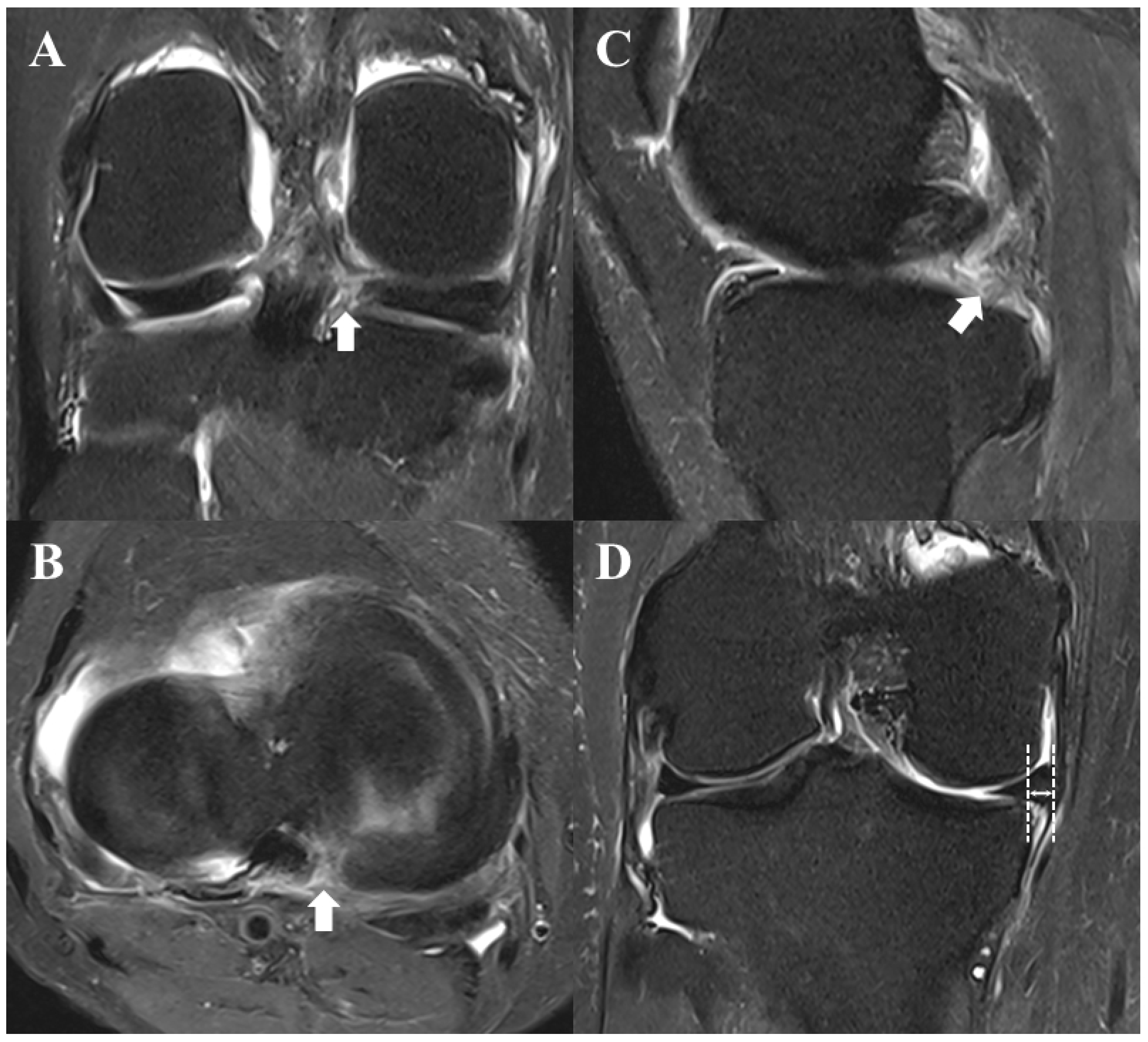 Medicina Free Full Text Medial Meniscus Posterior Root Tear How Far Have We Come And What