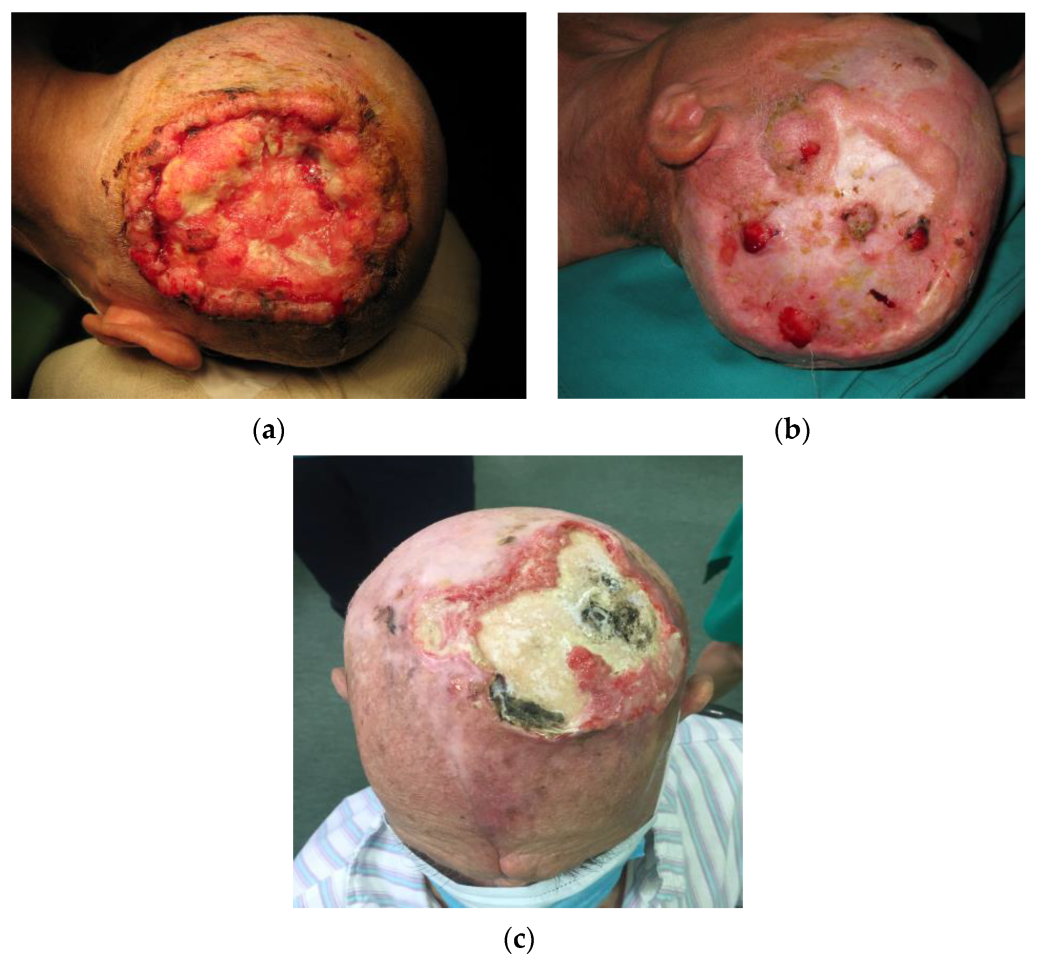 Ringworm, Scalp (Tinea Capitis) Condition, Treatments and Pictures