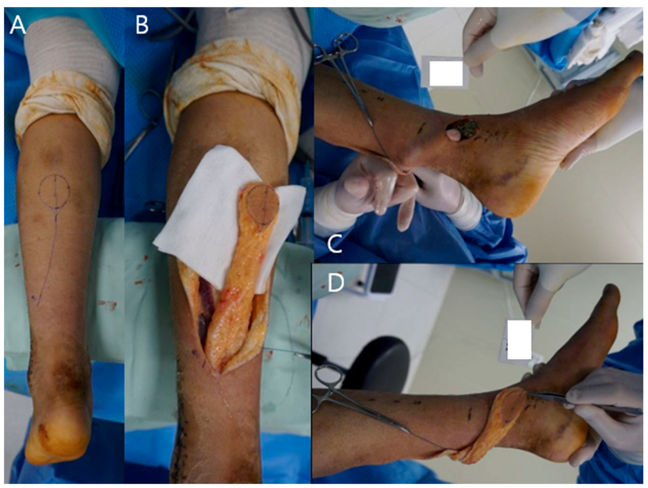 PDF] Functional Outcomes and Quality of Life Following Complex Tibial  Fractures Treated with Circular External Fixation: A Comparison between  Proximal, Midshaft, and Distal Tibial Fractures