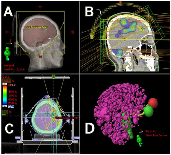 What is Whole Brain Radiation Therapy? 