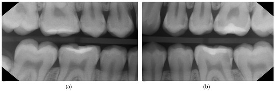 a) Depicting visible fracture lines within the enamel suggestive of