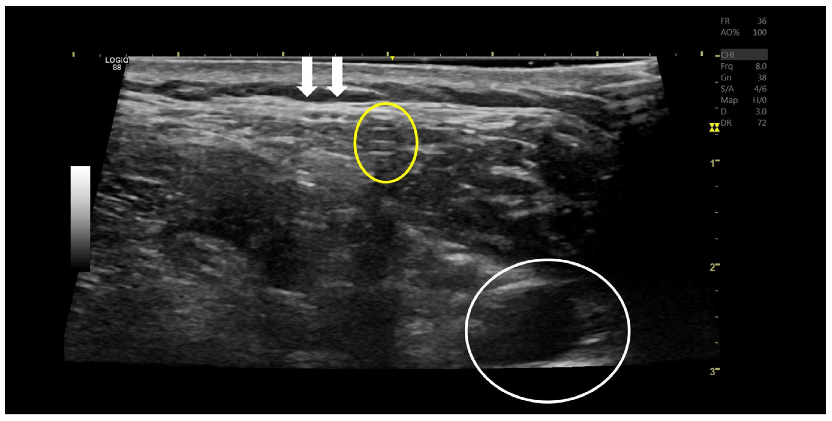 Medicina Free Full Text Successful Ultrasound Guided Superficial