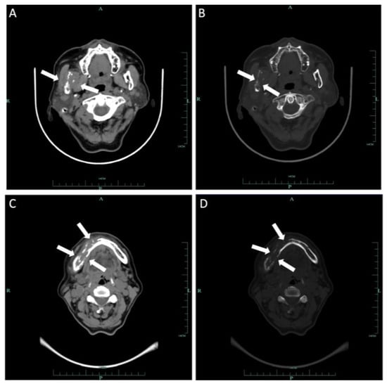 Medicina Free Full Text Primary and Recurrent Intraosseous