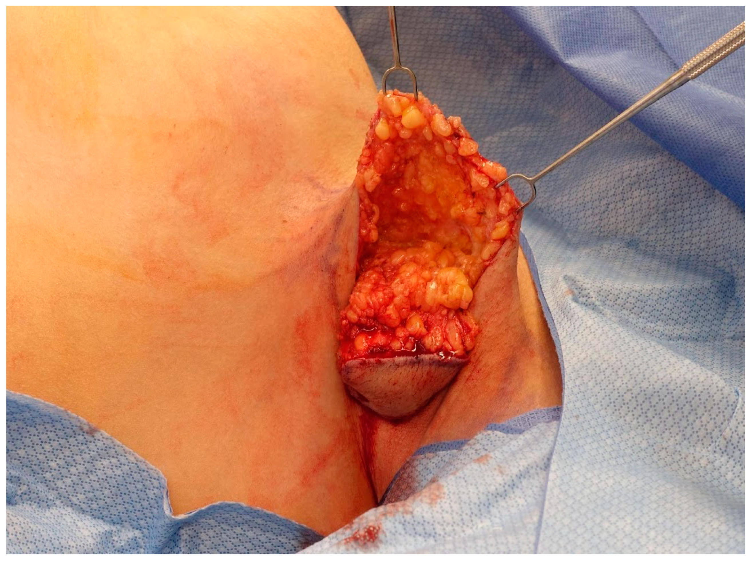 Armpit fat removal before and after 2 months post-op. This patient had  excess axillary breast tissue, which is genetic and can grow as the breast  grows. The recovery time for this surgery