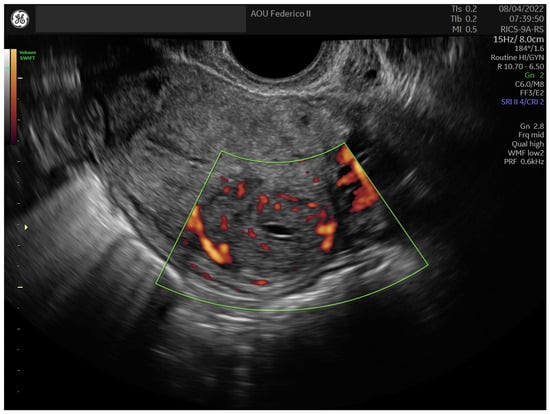 Cureus, Large Haemoperitoneum Caused by a Ruptured Endometrioma: A Case  Report